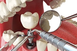 Implant dentar in Chisinau
